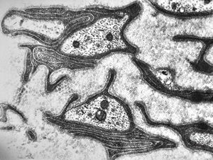 F,13y. | F,13y. | n.suralis … axonal neuropathy … Charcot-Marie-Tooth disease F,13y. | F,13y. | n.suralis … axonal neuropathy … Charcot-Marie-Tooth disease
